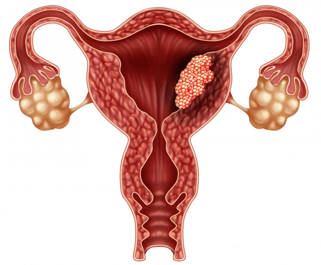 oasis Careful reading betrayal Endometrioza și infertilitatea. Mangementul medical și chirurgical al  endometriozei – Centrul Calla