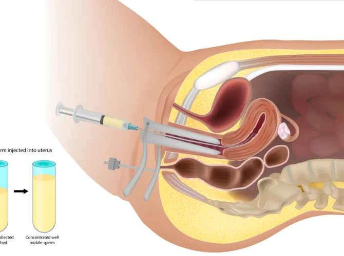 Inseminarea intrauterină – o șansă în plus pentru concepție
